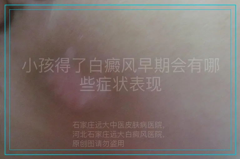 小孩得了白癜风早期会有哪些症状表现