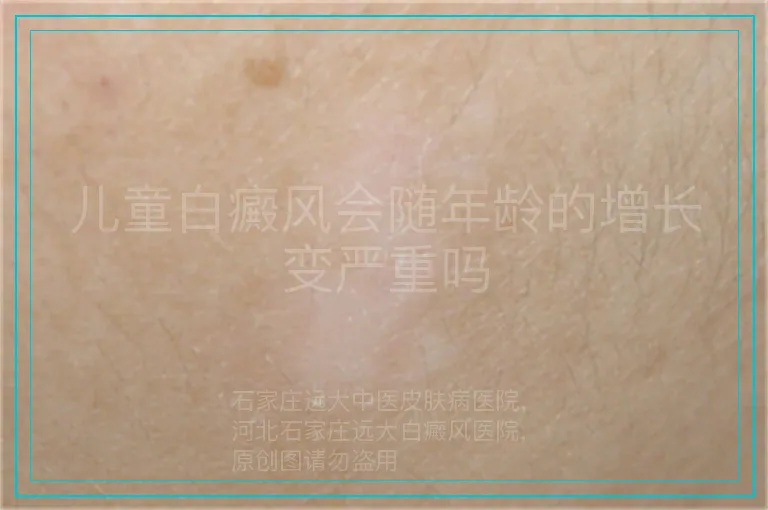 儿童白癜风会随年龄的增长变严重吗