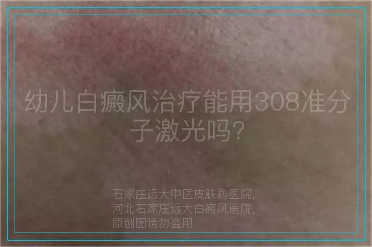 幼儿白癜风治疗能用308准分子激光吗?