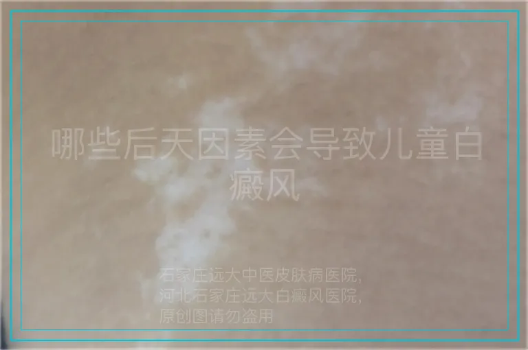 哪些后天因素会导致儿童白癜风