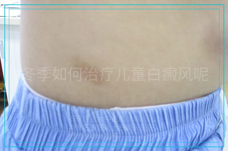 冬季如何治疗儿童白癜风呢
