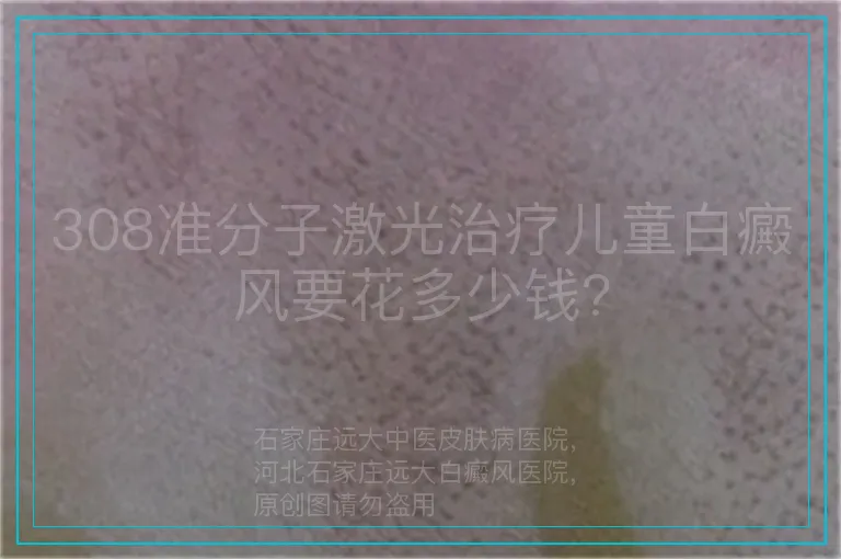 308准分子激光治疗儿童白癜风要花多少钱?