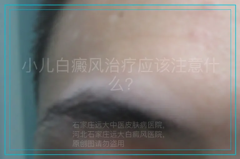 小儿白癜风治疗应该注意什么?