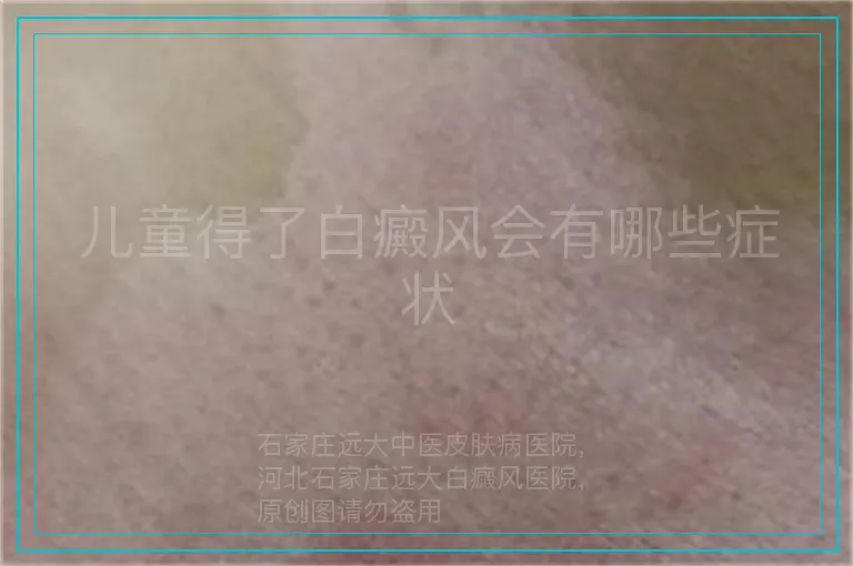 儿童得了白癜风会有哪些症状