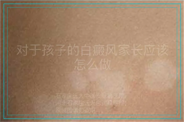 对于孩子的白癜风家长应该怎么做
