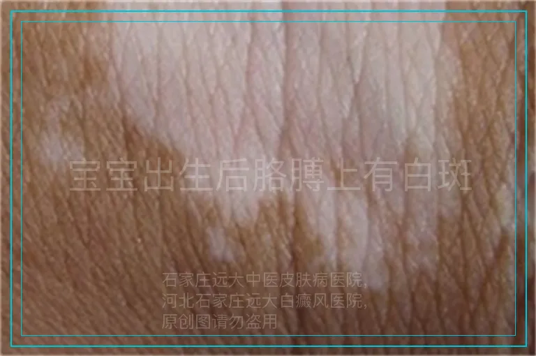 宝宝出生后胳膊上有白斑