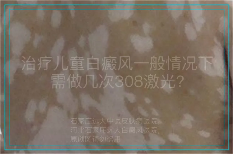 治疗儿童白癜风一般情况下需做几次308激光?