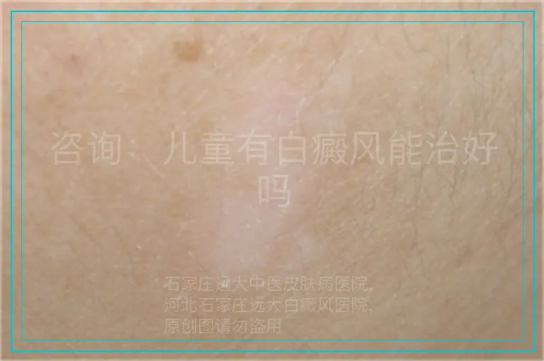咨询：儿童有白癜风能治好吗