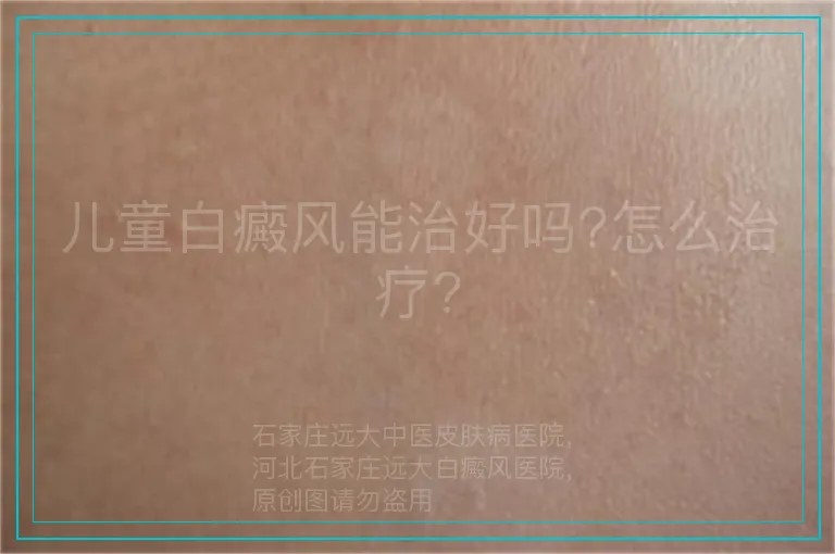 儿童白癜风能治好吗?怎么治疗?