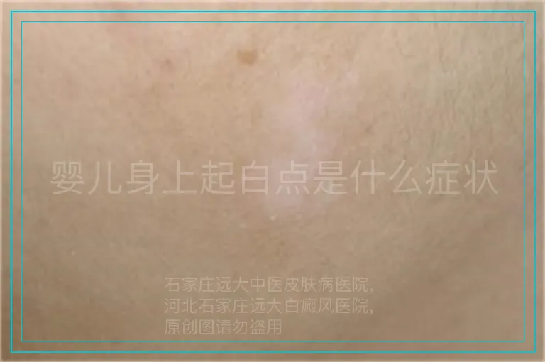 婴儿身上起白点是什么症状