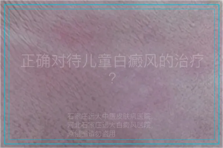 正确对待儿童白癜风的治疗?
