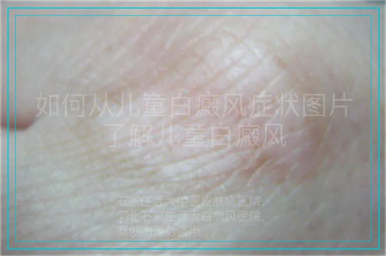 如何从儿童白癜风症状图片了解儿童白癜风