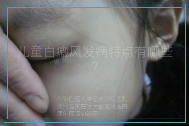 儿童白癜风发病特点有哪些？