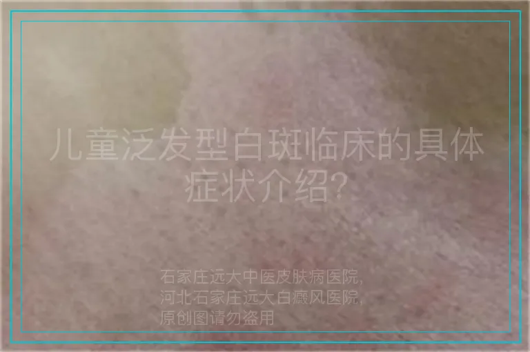 儿童泛发型白斑临床的具体症状介绍？