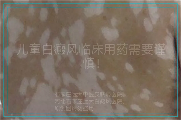 儿童白癜风临床用药需要谨慎！