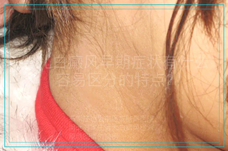 婴儿白癜风早期症状有什么容易区分的特点?