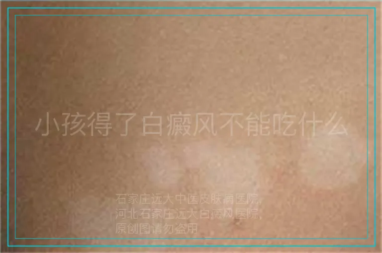 小孩得了白癜风不能吃什么