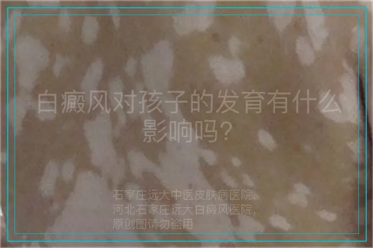 白癜风对孩子的发育有什么影响吗?