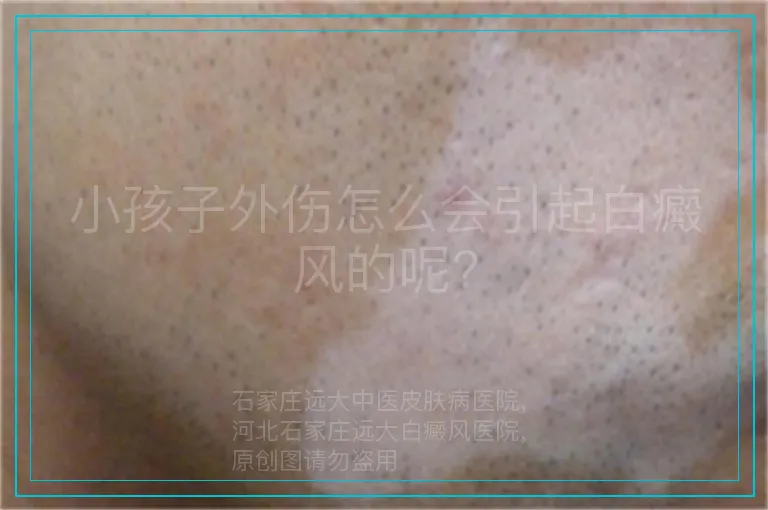 小孩子外伤怎么会引起白癜风的呢?