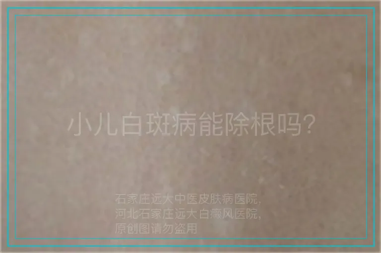 小儿白斑病能除根吗？