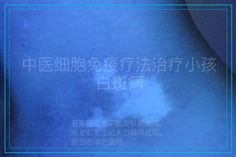 中医细胞免疫疗法治疗小孩白斑病