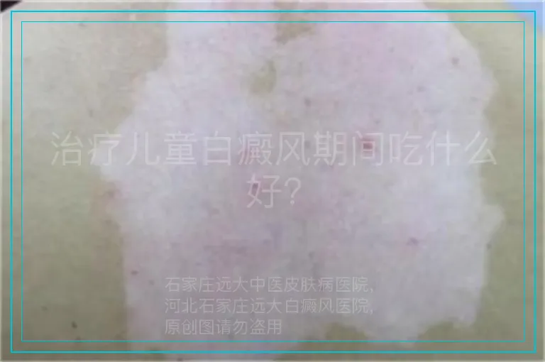 治疗儿童白癜风期间吃什么好?