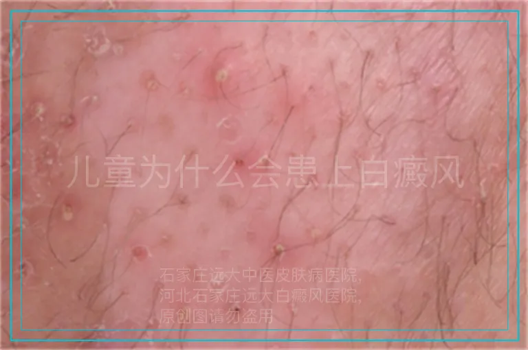 儿童为什么会患上白癜风