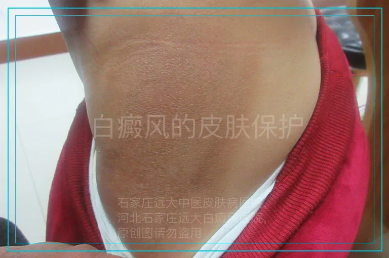 白癜风的皮肤保护