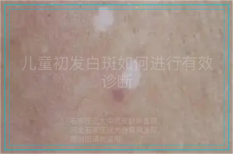 儿童初发白斑如何进行有效诊断