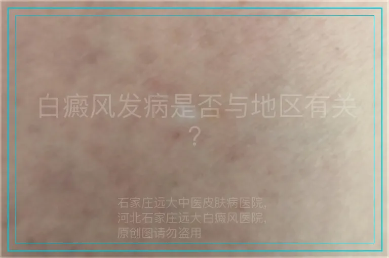 白癜风发病是否与地区有关？