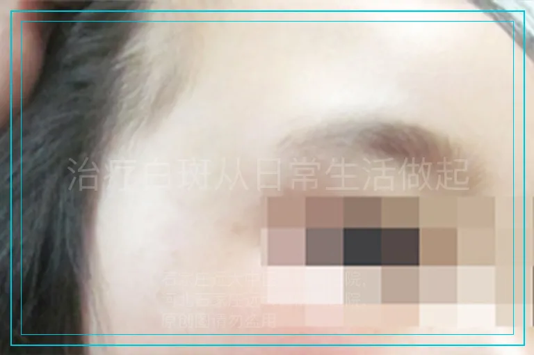 治疗白斑从日常生活做起