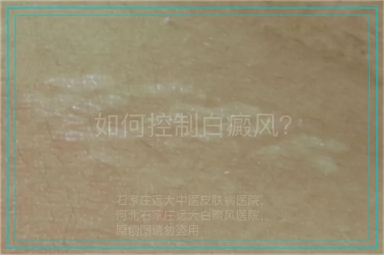 如何控制白癜风？