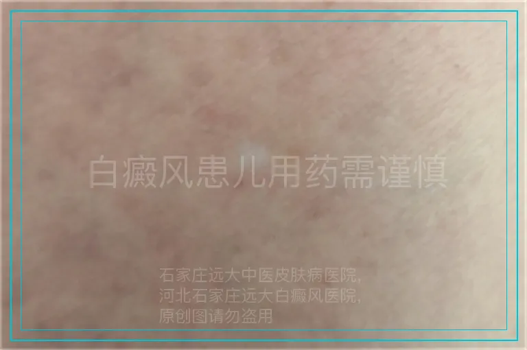 白癜风患儿用药需谨慎