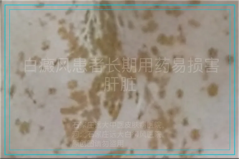 白癜风患者长期用药易损害肝脏