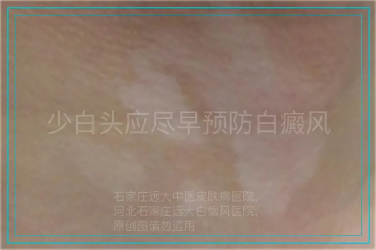 少白头应尽早预防白癜风