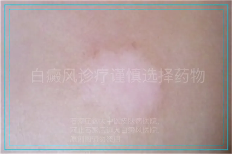 白癜风诊疗谨慎选择药物