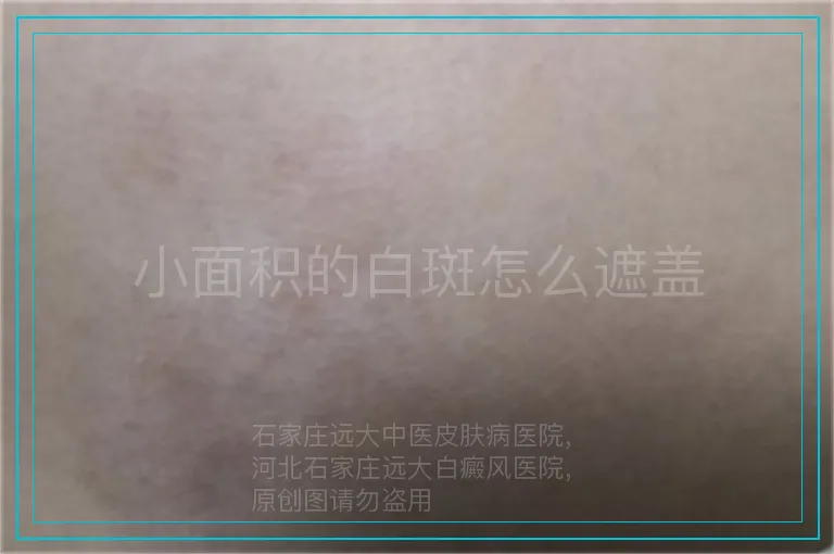 小面积的白斑怎么遮盖