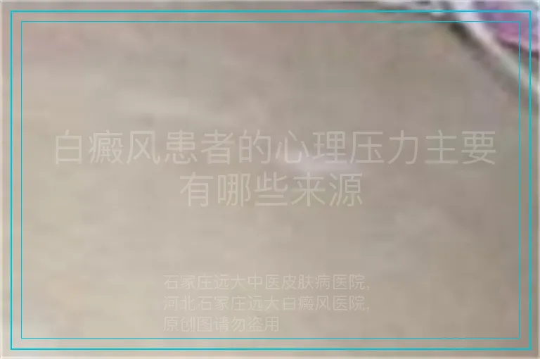 白癜风患者的心理压力主要有哪些来源