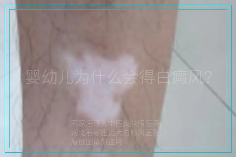 婴幼儿为什么会得白癜风？