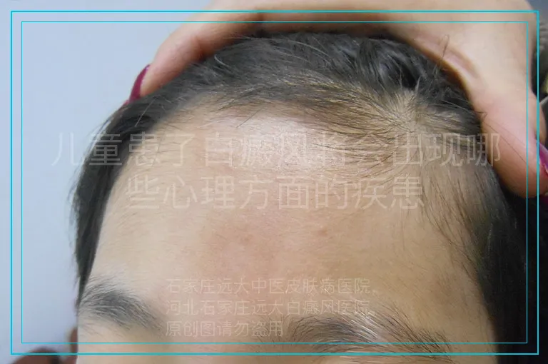 儿童患了白癜风将会出现哪些心理方面的疾患