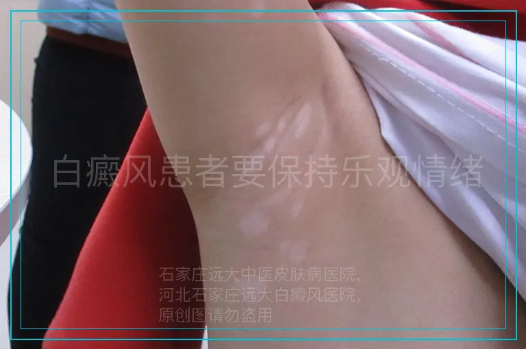 白癜风患者要保持乐观情绪