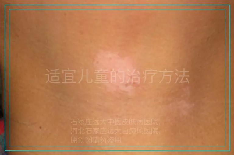 适宜儿童的治疗方法