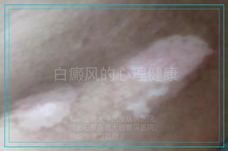 白癜风的心理健康