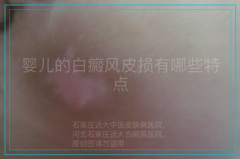 婴儿的白癜风皮损有哪些特点