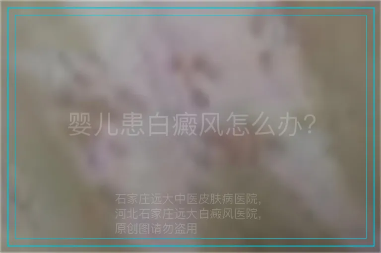 婴儿患白癜风怎么办？