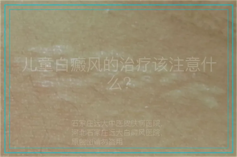 儿童白癜风的治疗该注意什么？