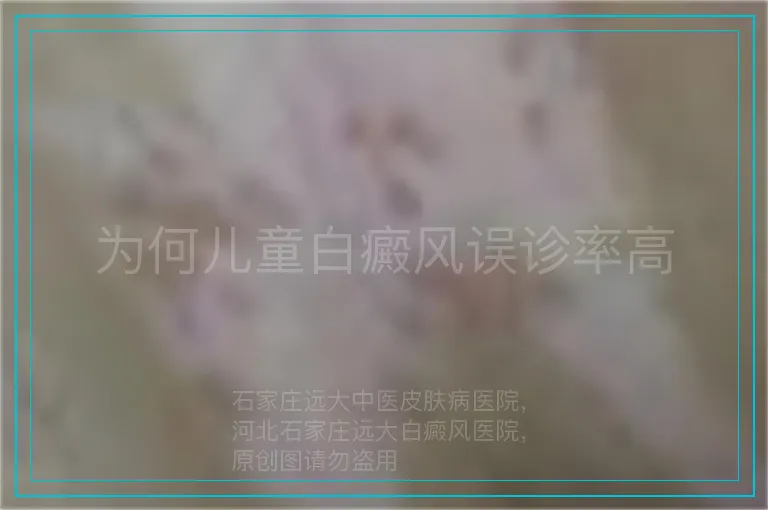 为何儿童白癜风误诊率高