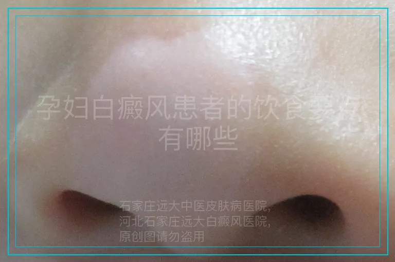 孕妇白癜风患者的饮食要点有哪些