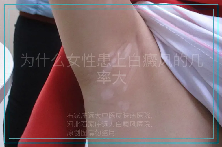 为什么女性患上白癜风的几率大