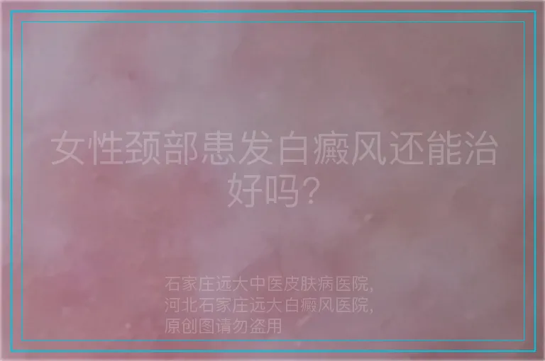 女性颈部患发白癜风还能治好吗?